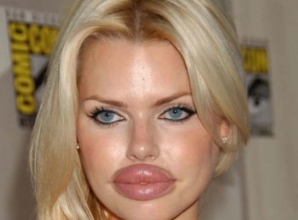 Nagyon jól sikerült ajakplasztikák. Fél órája röhögünk!