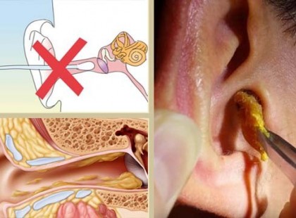 Okok és tippek a fülzsír otthoni eltávolításához