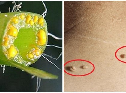 Szemölcsöd van? Itt van, hogyan lehet eltávolítani örökre!