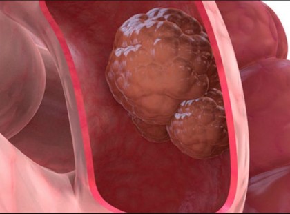 A vastagbélrák 6 tünete, amelyet nem szabad figyelmen kívül hagyni!