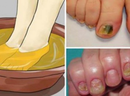 Ez a két szuper összetevő megszabadít a kellemetlen körömgombától