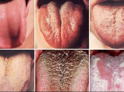 Vegyél egy közelebbi pillantást – nyelvünk színe elárulja, ha rákos megbetegedésünk van