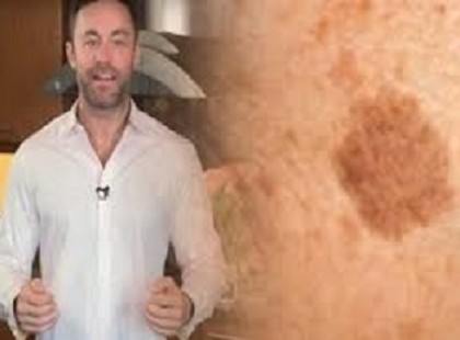 A híres bőrgyógyász elmondta a titkot: szabadulj meg a barna foltoktól és öregségi ráncoktól ezzel a filléres trükkel!