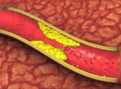 4 evőkanállal kell bevenni reggel, leszedi az artériák faláról a meszesedést, a rossz koleszterint, és leviszi a vérnyomást is ez az ital