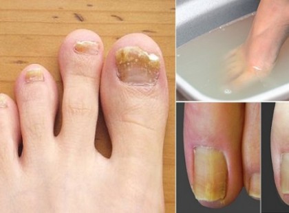 Csak ezt a két dolgot használtam, és megszabadultam a körömgombától hamar