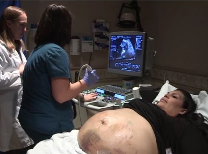 A terhes anyuka hasa tele volt zúzódásokkal. Majd az orvosok sokkoló dolgot fedeztek fel rajta...