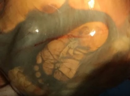 Csak a terhesség 41-ik hetében ment először orvoshoz… sokkot kaptak az orvosok attól, amit felfedeztek a hasában!