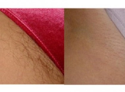 Szabadulj meg örökre a nem kívánt testszőrzettől!