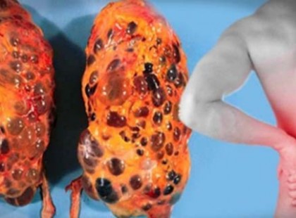 6 rossz szokás ami elpusztítja a vesédet – azonnal hagyd abba ezeket a dolgokat