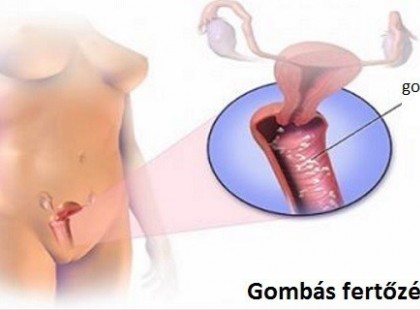 Nagyon sok nő szenved gombás fertőzéstől, pedig otthon is meg tudnák gyógyítani magukat