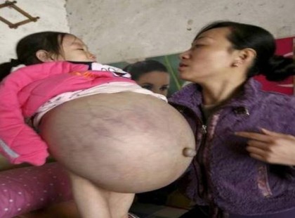 Ez a kislány úgy néz ki, mit aki terhes… Nem fogod elhinni, mi van a dolog mögött!