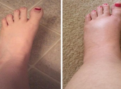 Ezzel az 5 módszerrel gyorsan kihajthatod a megrekedt vizet a testedből