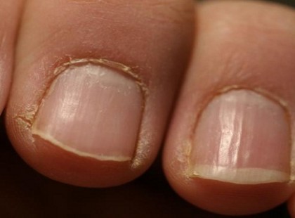 Vörös riasztás: Ha látod ezt a körmödön, azonnal menj orvoshoz!