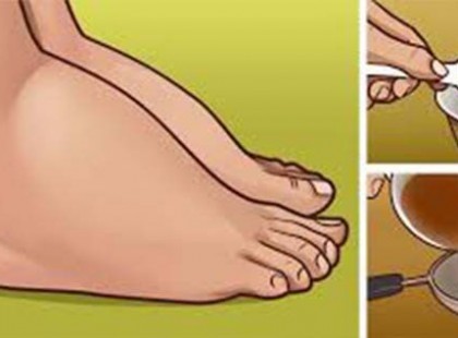 Ezzel az 5 módszerrel gyorsan kihajthatod a megrekedt vizet a testedből