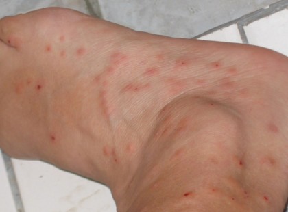 Vigyázat, egyre gyorsabban terjed a kórság! Ha ilyen foltot lát magán azonnal ellenőrizze az ágyát, könyveit, ruháit, függönyeit, szekrényeit, bőröndjeit! Otthon és idegen helyen is! Itt vannak a részletek