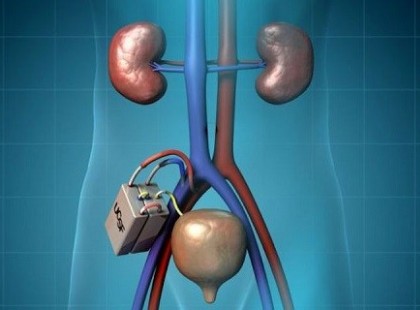 A kutatók búcsút mondanak a dialízisnek, feltalálták a bionikus vesét!