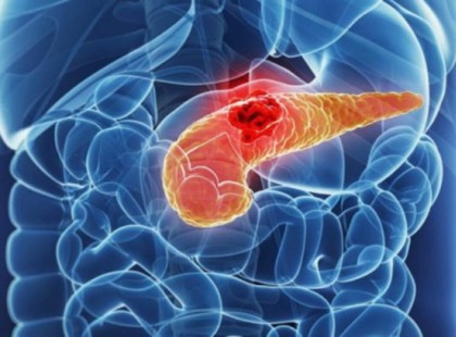 A hasnyálmirigyrák alattomos betegség, mert nem okoz fájdalmat. Ám mégis van pár tünete