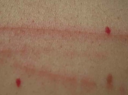 Vigyázat! Vannak ilyen piros foltok a bőrödön? Itt van az oka, hogy miért …