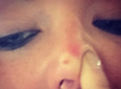 Figyelem! Ha ilyet lát a testén azonnal forduljon orvoshoz, napokat se várjon, haladéktalanul keresse fel a bőrgyógyászatot! Egyre gyakoribb!