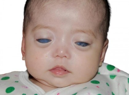 Senki sem fogadta örökbe a kékes-szürke szemű kislányt aztán egy fénykép mindent megváltoztat