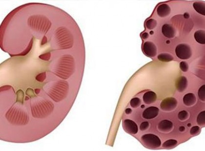 10 szokás, ami súlyosan károsítja a vesédet