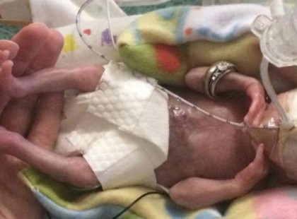 Senki sem hitte el hogy a 21 hetes baba életben marad - nézd hogy néz ki most