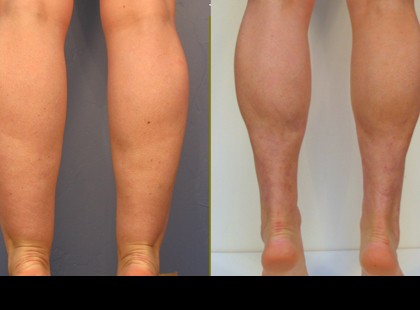 Az öt leghatékonyabb vízhajtó módszer