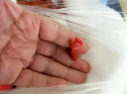 Elképesztő fotók: 12 héttel korábban született meg a világ legkisebb babája – És túl is élte, sőt... – galéria