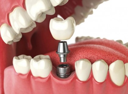 FOGPÓTLÁS ÁLLAMI TÁMOGATÁSSAL! SZINTE SENKI NEM TUD RÓLA PEDIG LÉTEZIK MINDEN KOROSZTÁLYNAK! Bárkinek járhat állami támogatás fogpótlásra is 18 év alatt, 18 -62 éves korosztálynak és 62 év felettieknek is! Itt vannak a hivatalos tudnivalók az igénylésről!