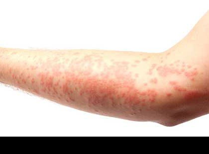 MTI figyelmeztetés! Ha Ön is vett ilyet jobban teszi ha leviszi a kukába, olyan súlyos allergiás rekaciót okozhat, aminek következményeit egész életében nem heveri ki! Szinte bárhol hozzájuthatott! MINDENKÉPPEN TÁJÉKOZÓDJON! ITT A FIGYELMEZTETÉS!