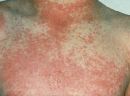 Szülők figyelem a skarlát visszatért – 5 figyelmeztető jel, amit soha nem szabad figyelmen kívül hagyni