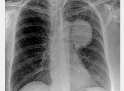 Édesanyám egy hónap alatt gyógyult ki a tüdőrákból ezzel a módszerrel. Naponta három kiskanállal ebből a keverékből: