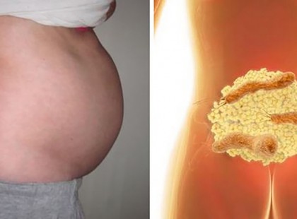 EZ A BAKTÉRIUM NEM ENGEDI, HOGY FOGYJ! ÍGY PUCOLD KI A SZERVEZETEDBŐL!