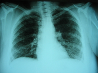 VIGYÁZAT! Új tüdőbetegség jelent meg az országban!! Veszélyesebb, mint a türdőrák és egyre több megbetegedést jelentettek!!! Ha időben felismeri még van esély!!! ÍGY ISMERHETI FEL IDŐBEN