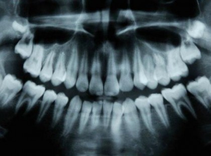 Egy szupergyógyszer képes 6 hét alatt regenerálni a fogakat!