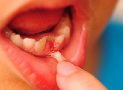 Szülők figyelem!!! SEMMIKÉPPEN NE DOBJA KI A GYERMEK TEJFOGAIT! Később megmenthetik az életét! Nagyon fontos figyelmeztetés minden szülőnek!