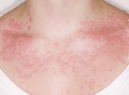 Vigyázat!!!! Nyáron százezrek csinálják, de tragikus vége lehet, amiről fogalmad sincs!!!! EZT SOHA TÖBBÉ NE TEDD, mert olyan allergiát válthat ki, aminek nyomát egész életedben viselni fogod!