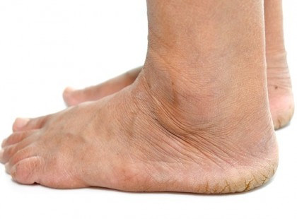 Vigyázzatok!!! Idegkárosodással járó betegség pusztít a magyarok körében! Napról napra többen betegszenek meg! Egy egyszerű zsibbadással kezdődik, amiről tudomást sem veszel!!!! >>>