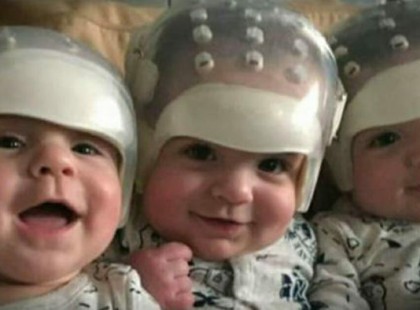 A hármasikrek különleges külsejük miatt bekerültek az orvoslás történetébe a műtét után