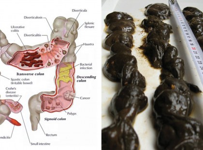 Ez a citromos, almás, gyömbéres lé nem engedi, hogy a mérgek zsírként tárolódjanak, egyszerűen kisöpri a máj segítségével a toxinokat!