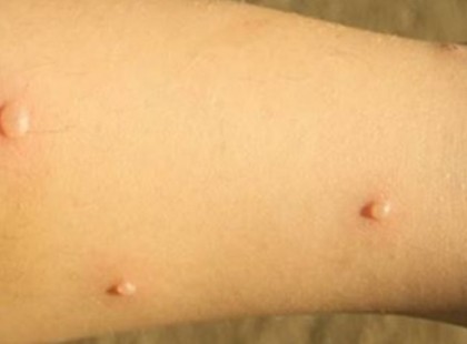 Szibériából jön a halál! Milliók pusztulnak el, ha ez a jóslat beteljesül! Egy réges régen elfeledett könyörtelen betegség jelent meg!!!!