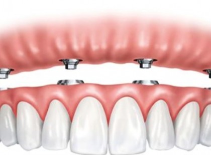 Fontos! Százezreknek érkezett fontos információ! Így kérhet pénzt, támogatást méltányosságból az államtól fogorvosra, fogászati beavatkozásra, fogpótlásra, szájsebészeti kezelésre! Íme az ONYF hivatalos tájékoztatója!!!!