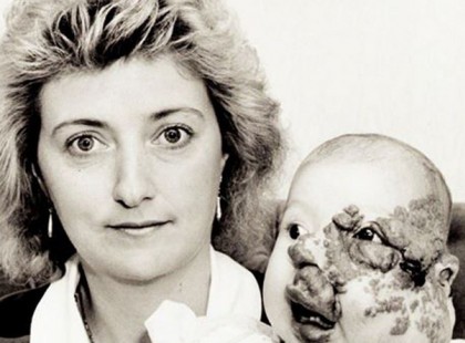 Ez a kislány egy tumorral az arcán született – így néz ki 26 évvel később esküvője napján