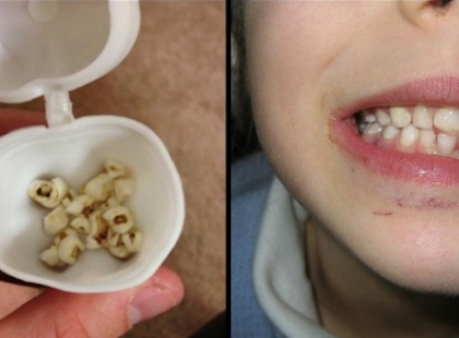 Szülők figyelem! Soha többé ne dobjátok ki a gyermekeitek kihullott tejfogait, mert az életét is megmentheti később - Orvosok kérik a megosztást, mert nagyon fontos, mégis csak kevesen tudnak erről!