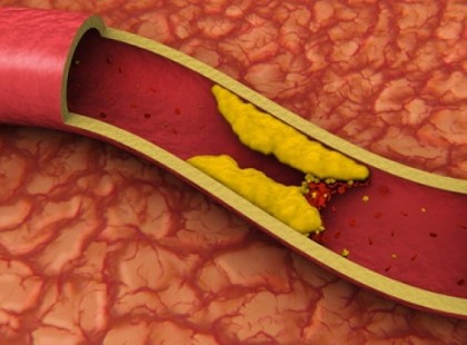Úgy átvertek minket a magas koleszterin szöveggel, hogy még most sem kapunk levegőt! Egy orvos-kutató leleplező írása. Itt az igazság a koleszterinről >>>