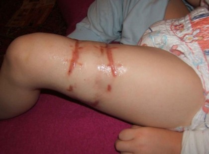 Borzalmas tragédia! A 7 éves kisfiúnkat Eriket megtámadta egy kóbor kutya és Ezt a szörnyűséget művelte vele - Hatalmas szüksége van a segítségetekre! Könyörgöm Osszátok!