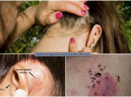 Ezt nem szabad figyelmen kívül hagyni! A nyirokcsomók előre jelzik a parazitákat és sok esetben a rákot is!