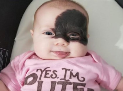 A kislány egy folttal az arcán született – szülei szuperhőst csinálnak belőle