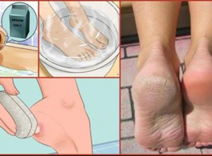 Ne költs pedikűrre! Használd ezt a két összetevőt a konyhádból és varázsold széppé lábaidat!