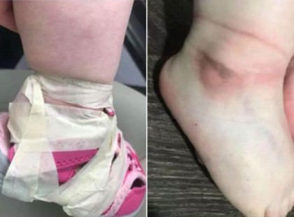Ragasztószalaggal kötözik kislánya lábához a cipőt a bölcsődében – a dühös anya a Facebookon reagál